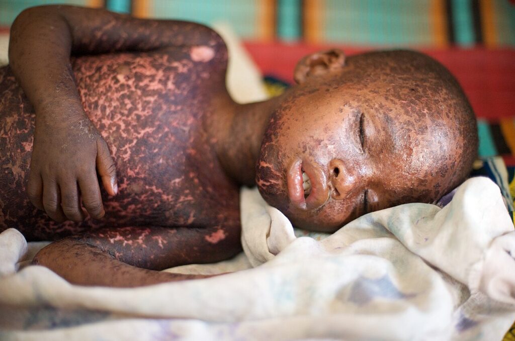 A child with a severe measles rash
